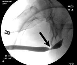 urethral stricture urethra strictures urethal causes diagnosis urinate f1 genitourinary urine urinary ray symptoms pance inability breakthrough suffering normally medical